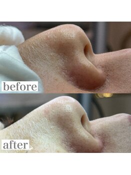 ライカブルー(RaicA BluE)/施術写真 before-after