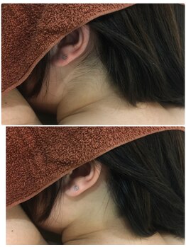 叶(Kanau)/うなじ脱毛