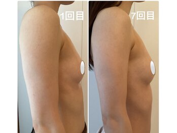 美バストアルファ(美bust α)/【光豊胸】症例