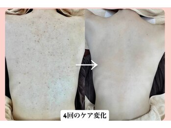 スキンハピネス(skinhappiness)/背中ハーブピーリング