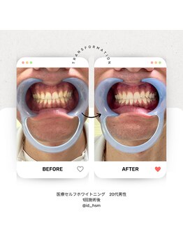 アイディー(Id)/生まれた本来の歯の白さに