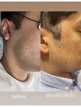 シール(Syl)/ヒゲ脱毛