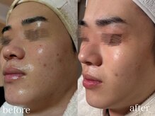 ネオリー(neorii)/ハーブピーリング