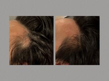 キクキク(KIKUKIKU)/円形脱毛のBefore After