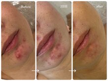 ナポデイズ(NAPODAYS)/しつこく繰り返すあごニキビケア