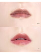 ドクターメラニン ラボ トーキョー 渋谷(Dr. Melanin Labo TOKYO)/唇メラニンケア症例
