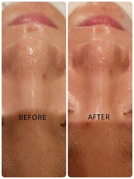 サロン ドゥ メビウス 春日店(salon de mebius)/毛穴洗浄