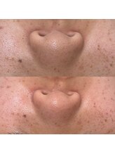 アンドラスター(andlaster)/やればハマる毛穴洗浄！！☆