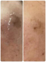 リズ ボーテ/本気で肌質改善ハーブピーリング