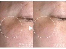 アリエルリッチ/シミ【美肌ケア】