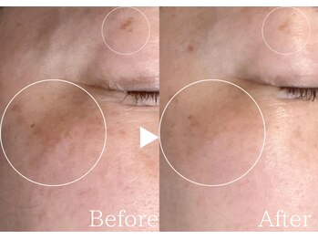 アリエルリッチ/シミ【美肌ケア】