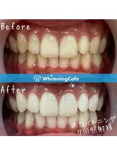 ホワイトニングカフェ イオン新潟青山店(WhiteningCafe)/