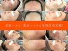 【まずは】一時的でないニキビ根本改善!!ニキビ専門サロン・お肌無料相談