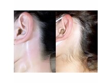 うなじやもみあげなどの顔WAX脱毛も大人気！綺麗に産毛除去◎