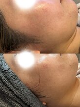 スムー 金沢小橋町店(Smoo)/ハーブピーリング