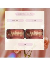 プラスビーセルフ(+b self)/ホワイトニングビフォーアフター