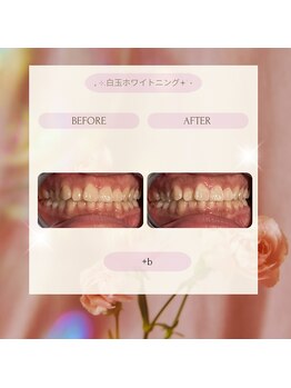 プラスビーセルフ(+b self)/ホワイトニングビフォーアフター