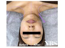 ラディアアンドココサロン(Radia&Coco_salon)/光フェイシャルビフォーアフター