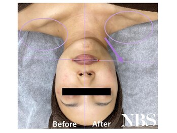 ラディアアンドココサロン(Radia&Coco_salon)/光フェイシャルビフォーアフター