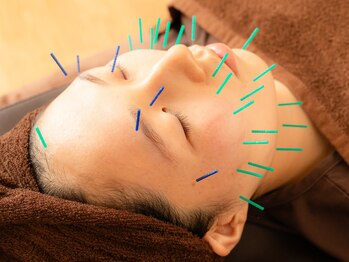 リリア(Riria)/美容鍼♪痛みが少ない鍼ケア