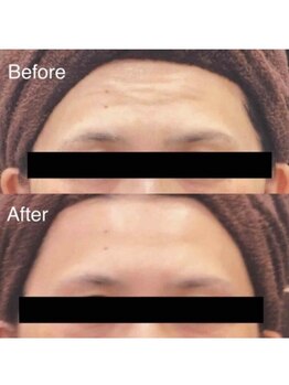 ブランシェ 高岡店 × 椿/シワ・たるみケア　お客様