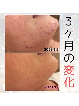 プルーム 大橋店(plume)/ハーブピーリング