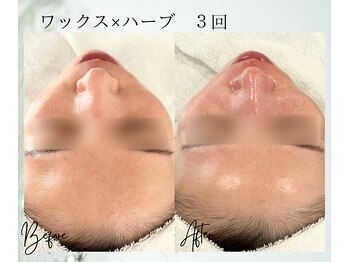 ポノ 茅ヶ崎(Pono.)/茅ケ崎/湘南/脱毛/毛穴/ハーブ