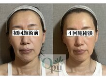 キュープ 相模原淵野辺店(Qpu)/たった4回で人生で1番小さな顔に