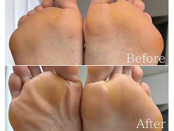 カシェット 広島店(Cachette)/40代女性☆足裏角質ケア90分