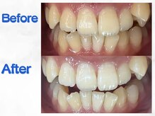 LBSホワイトニング 梅田店/ホワイトニングビフォーアフター