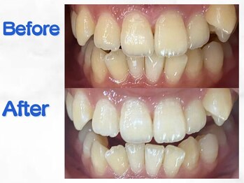 LBSホワイトニング 梅田店/ホワイトニングビフォーアフター