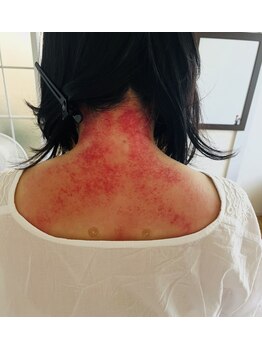 さとみ整体院/カッサ後(筋膜リリース)