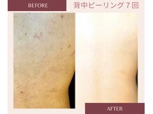 アブニールブリヨンの雰囲気（たった1回のケアで、すっきりハーブトリートメント★[背中ケア]）