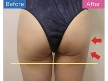 ルシータ(LuCita)/3D造形トリートメント