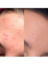 イエナ(IENA)/光フェイシャルが大人気♪