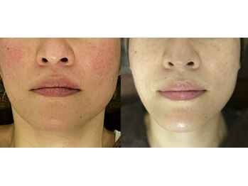 サロン ド クローバー(Salon de clover)/リジュビネーションコース 施術