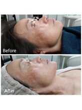 レン(Ren)/ラテスパ+ゾンビマスク+ハイドロ