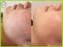 ハーブピーリング 名古屋/ニキビケア