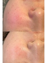 スムー 金沢小橋町店(Smoo)/ハーブピーリング