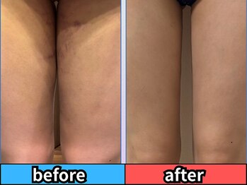 新宿術後インディバサロン【看護師監修/インディバ/ダウンタイムケア/都度払い】/