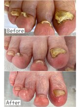 リゼラアンドコー 川越南古谷店/肥厚爪