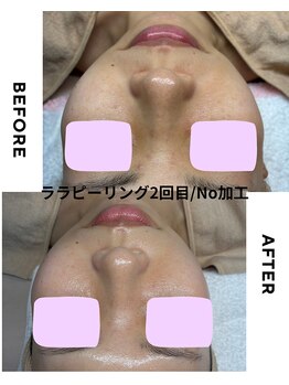 ジーンバイピエル 中野店(gene by PIEL)の写真/繰り返す肌荒れに/ララピール進化版で本気の肌質改善&LDMで水分補給【中野/韓国肌質改善】