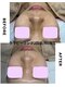 ジーンバイピエル 中野店(gene by PIEL)の写真/繰り返す肌荒れに/ララピール進化版で本気の肌質改善&LDMで水分補給【中野/韓国肌質改善】