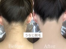 スマイルビューティラボ 別府店(Smile Beauty lab.)の雰囲気（まろめ髪が似合ううなじに◎【脱毛】Before /After）