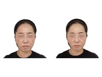 けいのき鍼灸整骨院/美容鍼1回の効果！小顔/小顔矯正