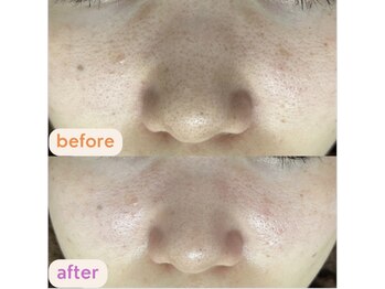 サクラ(SAKURA)/毛穴スッキリ◎