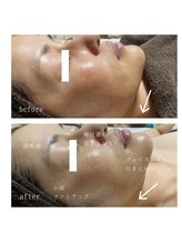 ヨリ(yori)/ハーブトリートメント1回