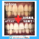 ホワイトニング明石