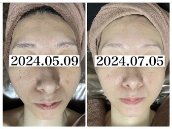 ホワイトアクア 北千住店(WHITE AQUA)/ララピール2ヶ月の変化/シミ改善