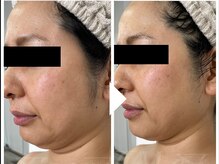 ビースト 下北沢店(B-st.)/フェイシャル｜全顔1回